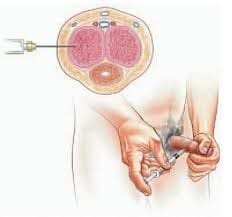 injection therapy